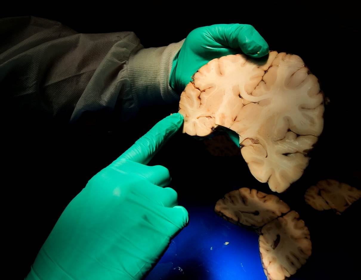 Dr. Ann McKee, director of BU’s CTE Center and chief of Neuropathology at the VA Boston Healthcare System, analyzed brain tissue in Jamaica Plain.